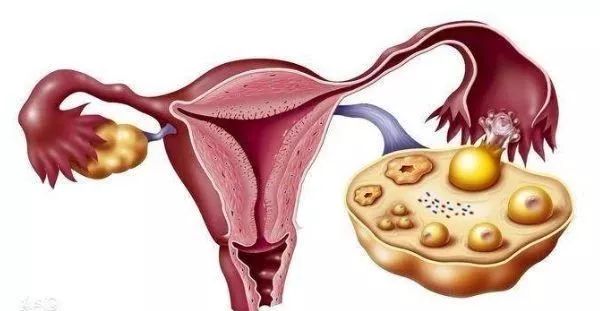 包括先天性卵巢发育不全,多囊卵巢综合征,卵巢功能早衰,宫颈病变,卵巢