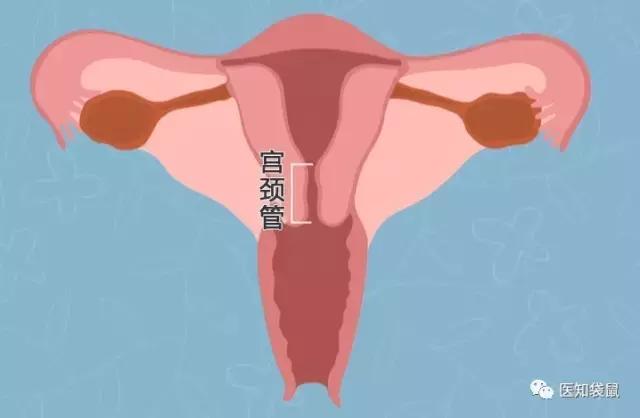 宫颈管位于子宫下部,上端与子宫体相连,下端深入阴道,形状近似圆锥体