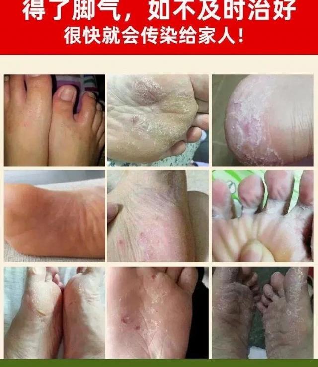 苗药品牌民间秘方脚气膏多年老脚气都治好了