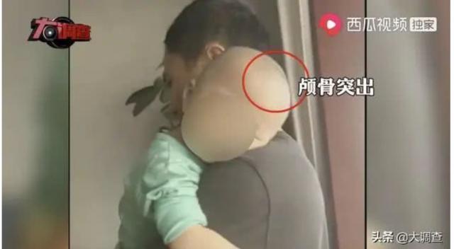 湖南郴州再现大头娃娃怎么回事小孩因喝假奶粉头大得让人害怕